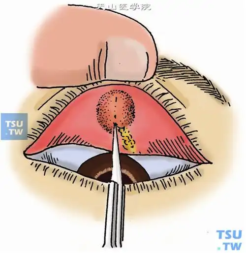 麦粒肿切开排脓术(针眼)步骤及临床经验