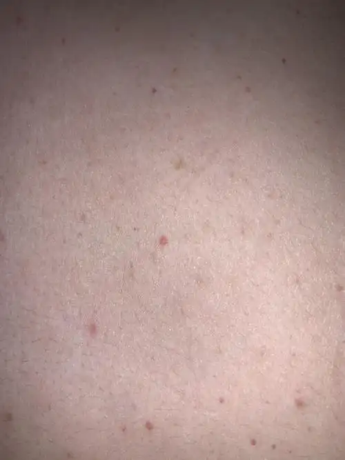 近两天时间陆续出现,不痛不痒,下半身没有,期间去过一次养鸡场,吃过