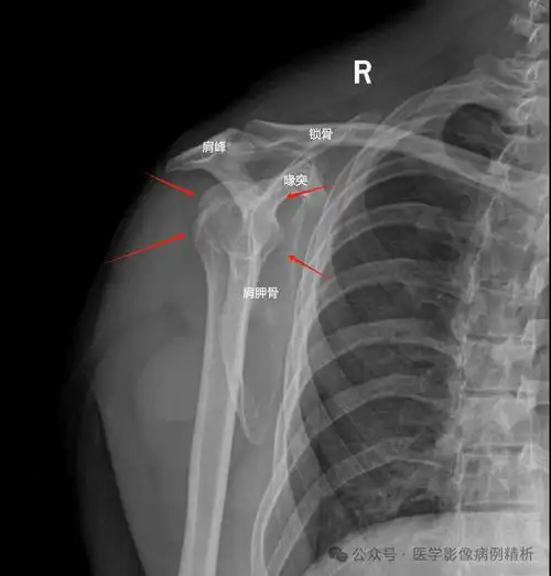 下图是一个肩关节的三维图像,非常形象的显示了复杂的