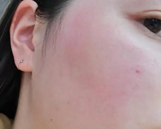 脸部遇热就经常泛红是什么原因啊啊啊啊!希望各位.