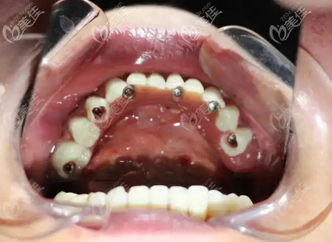 半口瑞士曼种植牙术后效果展示
