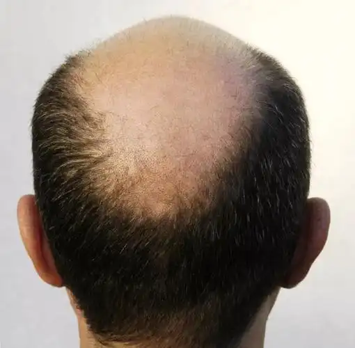 2,秃顶面积越大,植发效果越差.