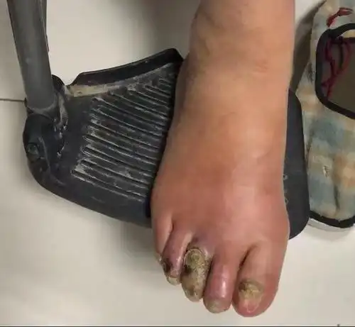 因为就在7年前,她的左腿也因为同样的症状,最后把大腿中段以下截肢了