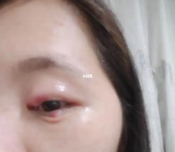 没有太在乎 大概快一个礼拜 右眼下眼皮起一个 开始左右眼疼,买了