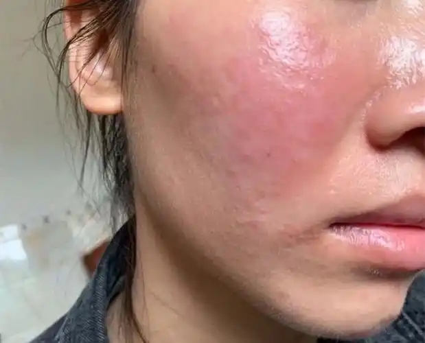 屏障受损"刚萌芽"时,皮肤隐约有4个"反常",别硬撑到"激素脸"!