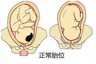 胎位loa是什么意思