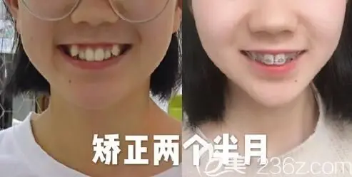 重庆牙齿矫正哪家好?公布牙博士虎牙矫正案例
