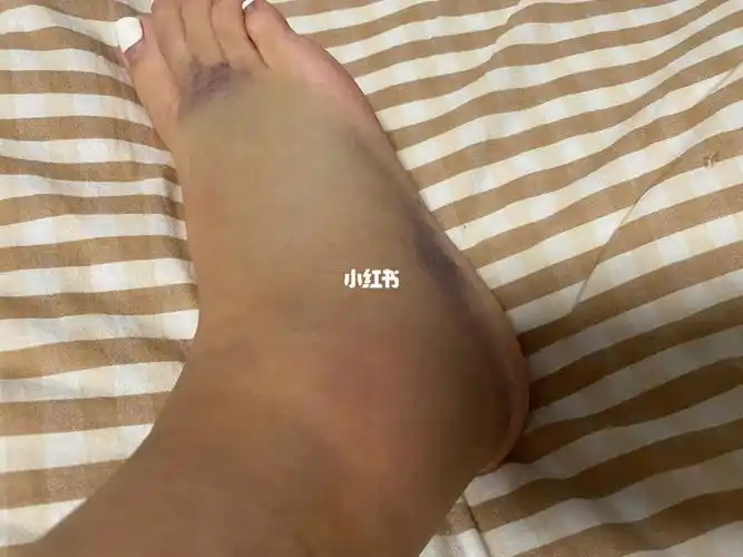 真没想到一个巨巨巨小的台阶 还没有高跟鞋高 能给我崴成这样 没骨折