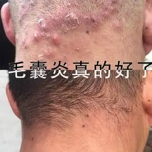 治头皮毛囊洗炎疗除螨虫脂溢性头部长痘痘有疙瘩止痒专用药水洗发