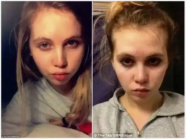 亲身体验熬夜40天结果我的脸毁了