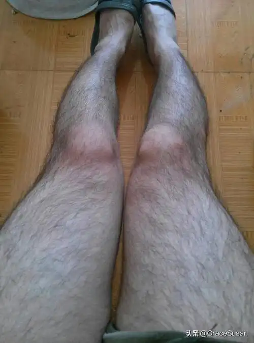 小孩汗毛多是什么原因?