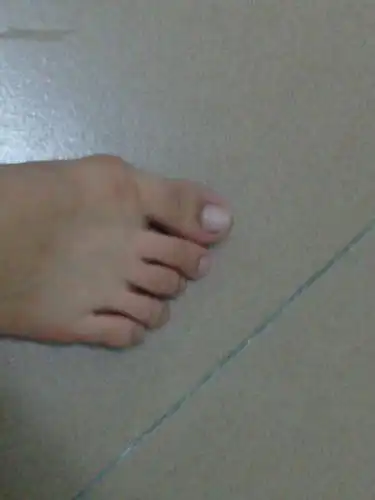 为什么我的大脚趾头旁,有块骨头会凹出去