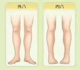 小孩走路外八/内八要紧吗?_宝宝