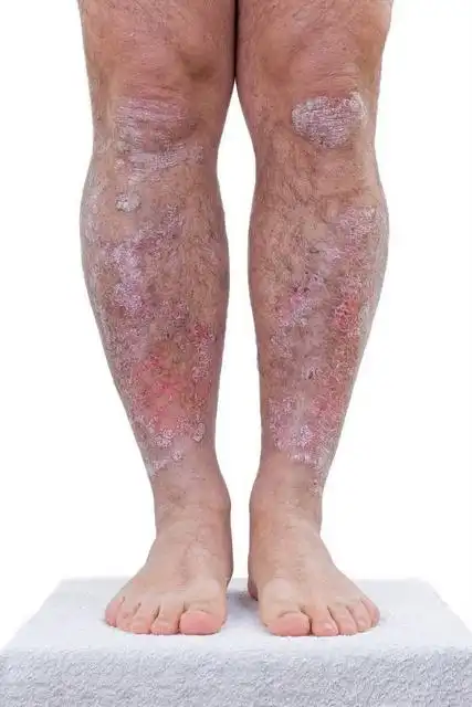 牛皮癣儿童早起图片_银屑病求医网