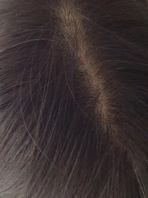 有没有同款头皮红痒的