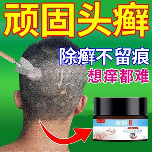 【专治头癣药膏】专治头癣药膏品牌,价格 - 阿里巴巴