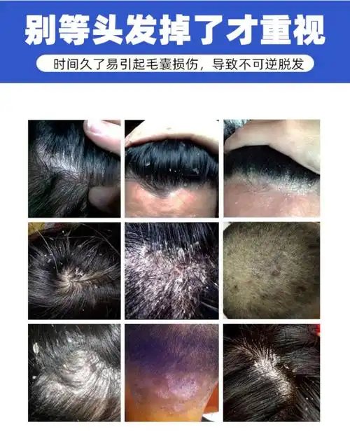 草木颂专治大块头皮屑毛囊洗发专治头皮屑癣藓头皮痒头发毛囊软膏头部