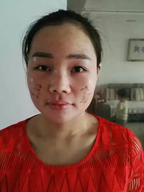 乳腺增生调理,脸部化妆品过敏调理后效果!