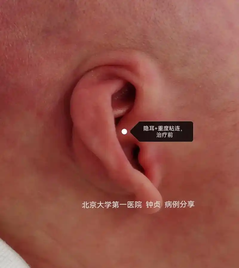 耳廓无创矫正病例分享,一例隐耳 重度粘连卷曲的病例.经过10 - 抖音