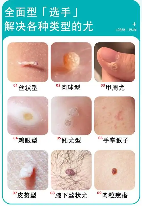 妥能 草本克疣液丝状疣脖子颈部去除肉粒疙瘩祛瘊子扁平尤克优膏疣瘊