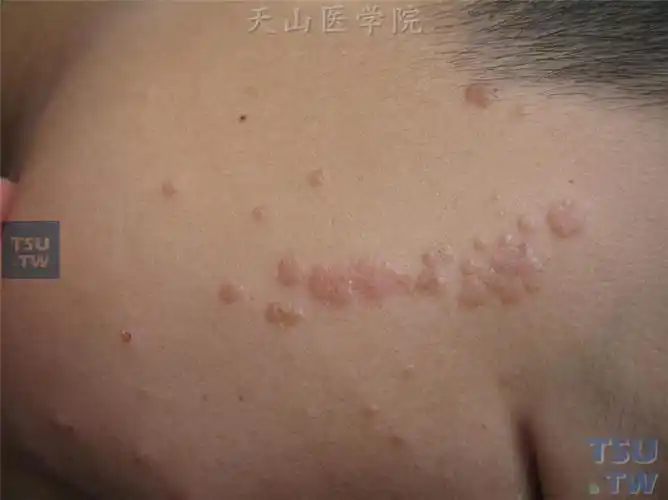 扁平疣(verruca plana)症状表现