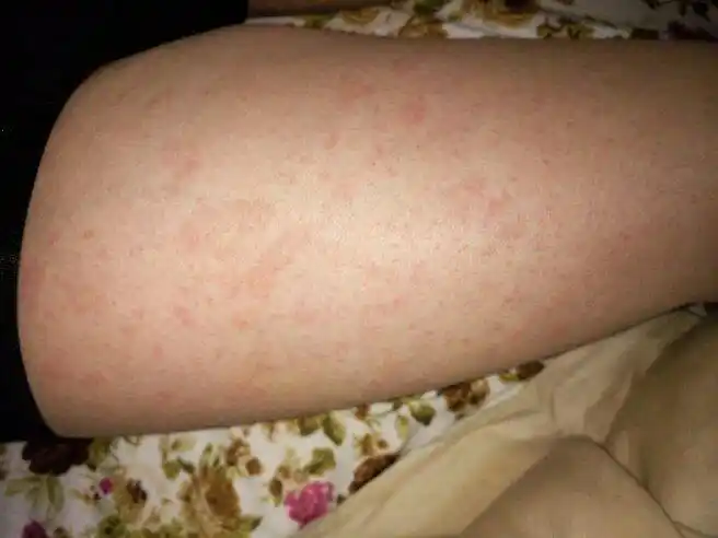 我皮肤有点干燥,有穿多带绒的衣服是不是皮肤过敏啊?