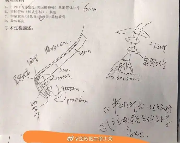 binder综合症是指先天性中面部凹陷,典型的特征是鼻发育不良和上颌骨