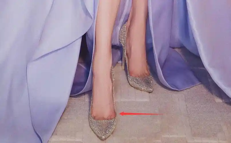 宋茜经常踩着恨天高跳舞外翻严重的大脚趾真惹人心疼