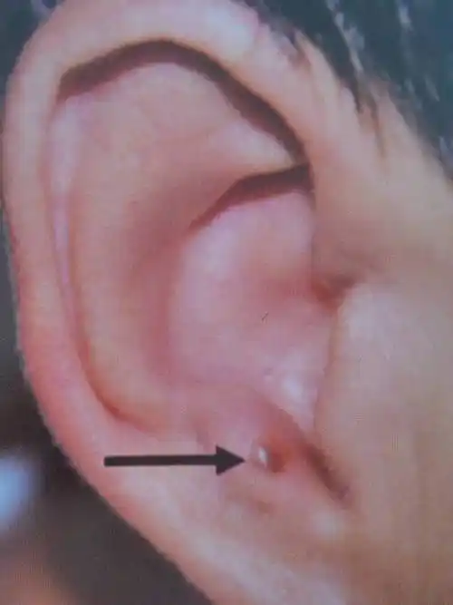 神奇的耳穴----耳穴视诊(垂体肿瘤)