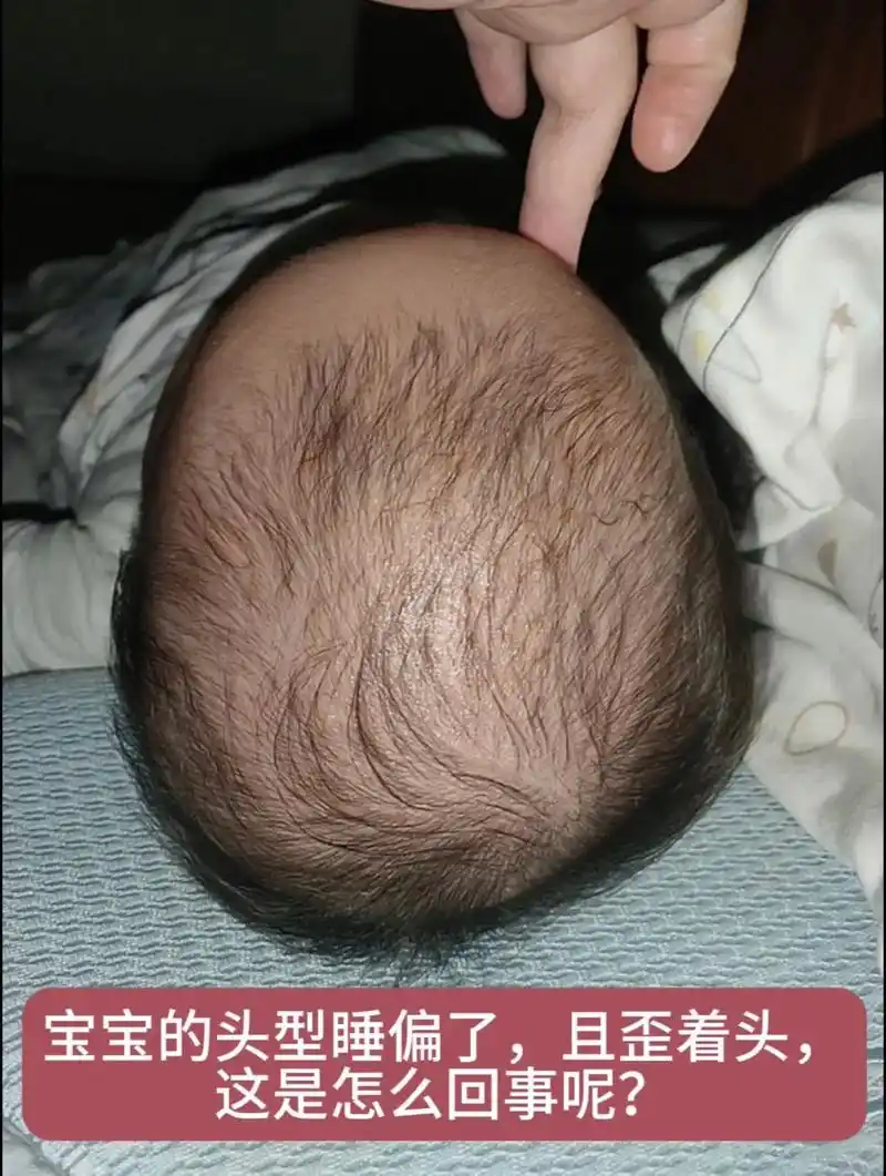 宝宝因为长期侧睡,头型偏了,头也有点歪.有的宝宝长期只一边侧 - 抖音