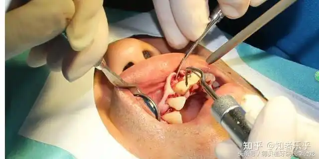 第一篇记第一次牙齿龈下刮治更复杂的洗牙手术