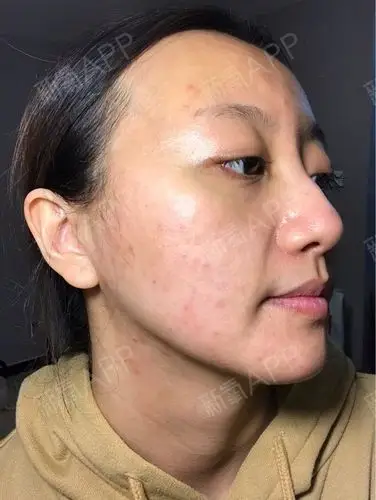 做完果酸焕肤的第6天