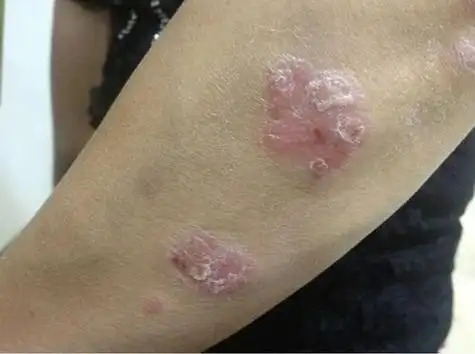 点状牛皮癣图片是怎样的:牛皮癣初期症状为针头或绿豆大小红色点丘疹