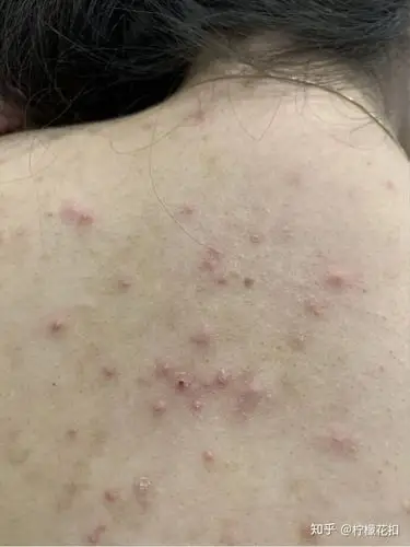 背上的痘痘怎么消去