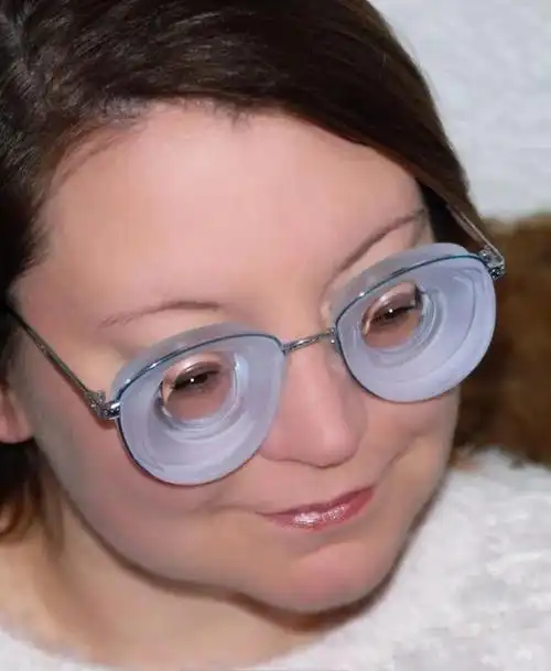 2000度的近视你见过吗?除了做icl晶体植入还可以戴rgp眼镜!