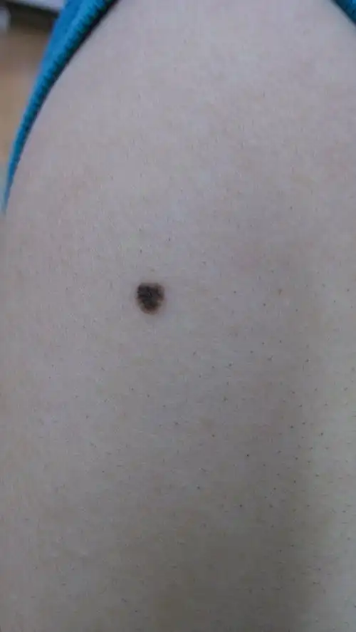 这是我右肩膀上的一颗痣,大约3毫米,不疼不痒,大约4年前就有,一直没