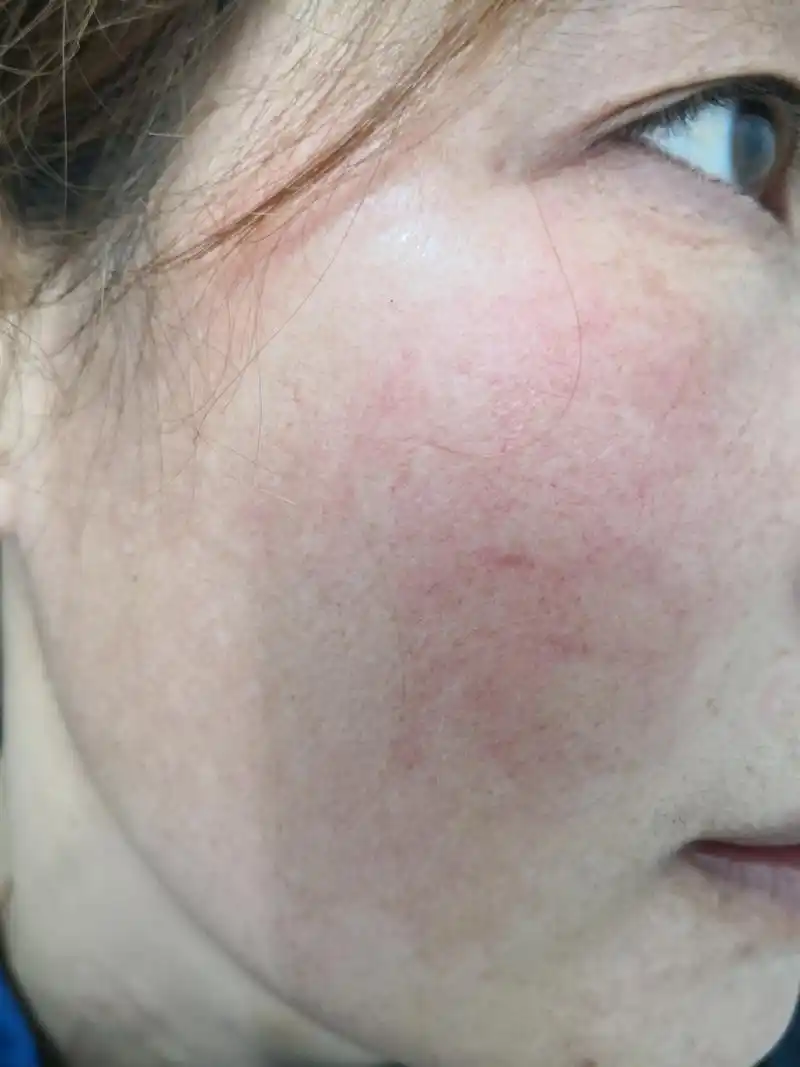 美容##红血丝# 抗卵磷脂抗体综合征.