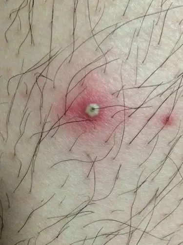 大腿上汗毛孔红肿,像是闷头,特疼,应该用什么药?