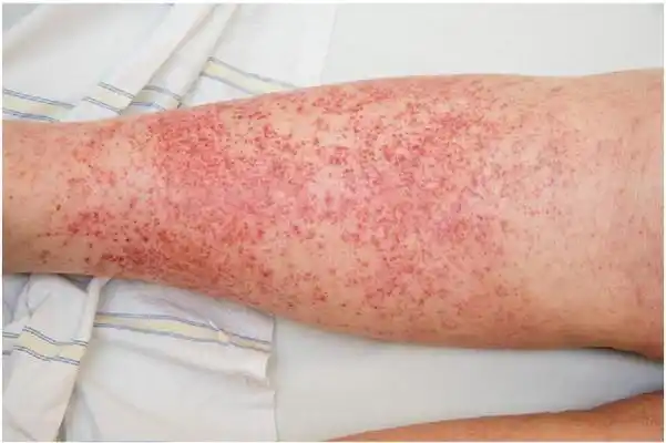 紫癜症状全面解析:身体如何反应?