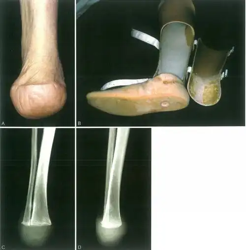 ⑵二期手术:syme截肢术⑴一期手术:胫腓骨近端融合术胫腓骨近端融合术
