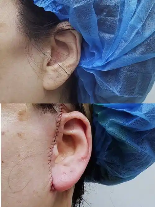 小切口拉皮手术做完几天拆线,切口恢复期几天?