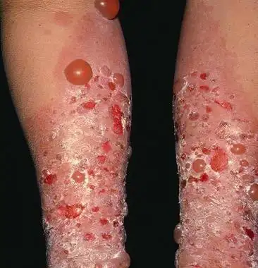 妊娠痒疹怎么治