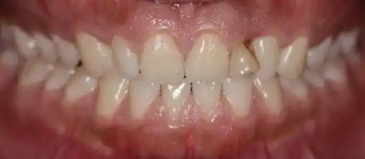 多学科联合治疗上侧切牙畸形过小牙一例——孙丽艳医师