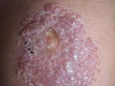 皮炎,可发生于情况下,但常见的原因是暴露于工作环境中的接触性过敏原