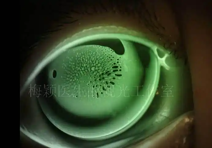 当角膜塑形镜下进入气泡(图1)时,镜片就会"隔着气泡压角膜",摘镜后在