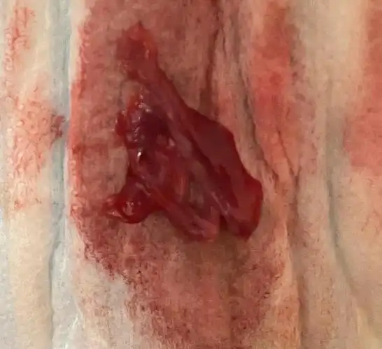 有图慎入月经全是血块是怎么回事