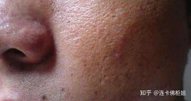 毛孔粗大,出油多,黑头多如何处理?