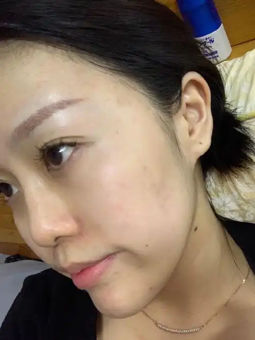 前三张术前的皮肤状态:皮肤粗糙三角区周围和唇周暗沉_圈子-新氧美容