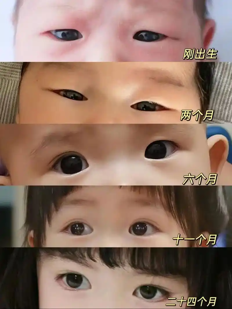 单眼皮成功逆袭成双眼皮 刚出生时还单着 两个月时也稳稳单着