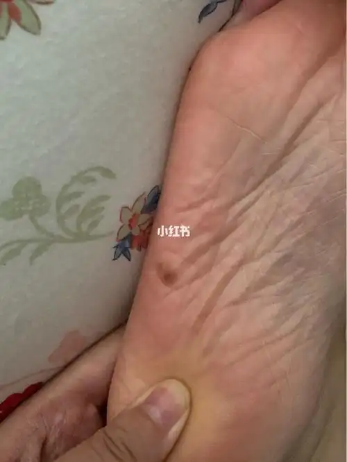 脚底大痣